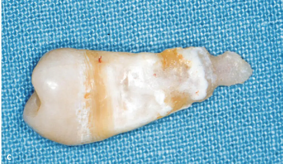 Abb 2a bis c 14jähriger männlicher Patient mit KindheitsHypophosphatasie - фото 54