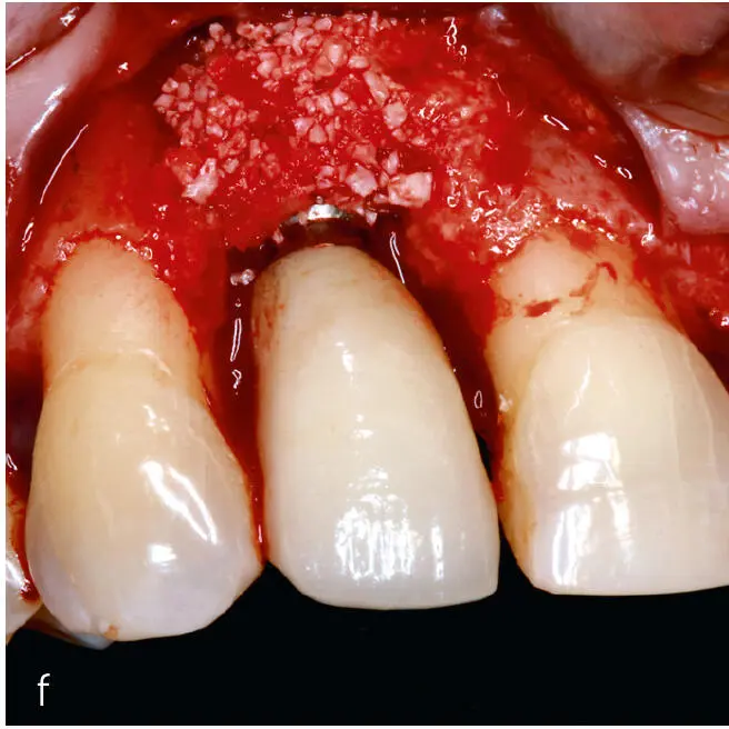 Abb 3a bis h Falldokumentation mit Zustand nach Implantatio - фото 30