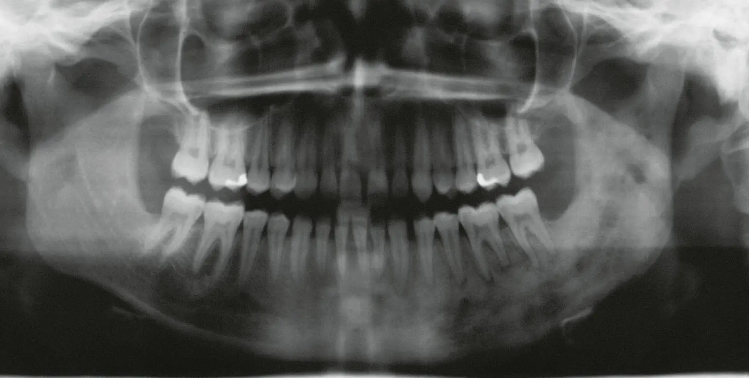 Abb 1 Osteomyelitis des Kiefers Die adjuvante Einlage von - фото 20