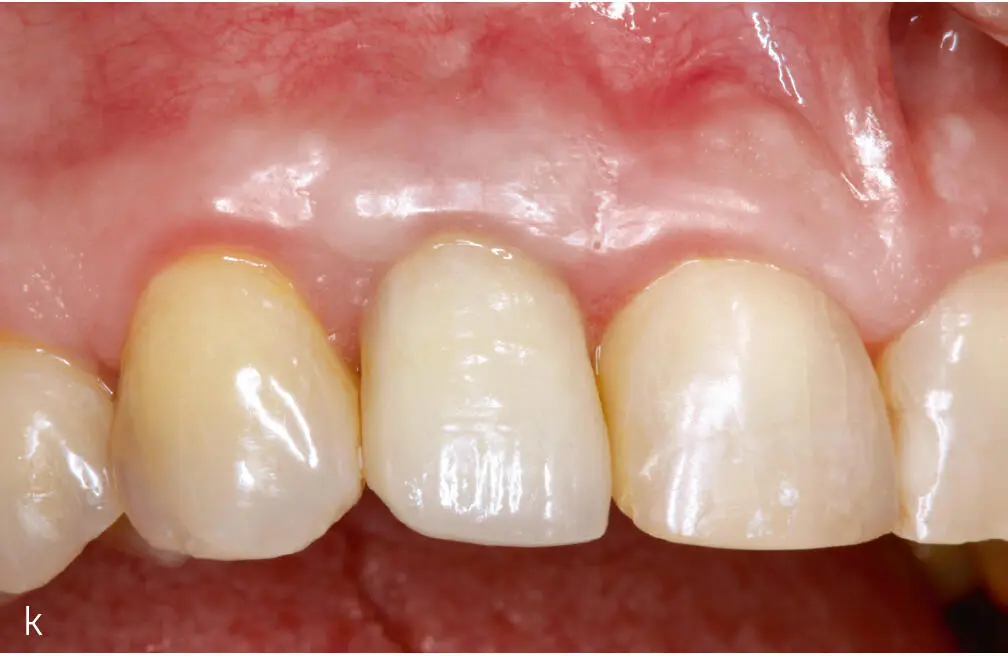 Abb 3i bis m Falldokumentation mit Zustand nach Implantatio - фото 35