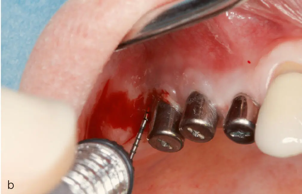 Abb 2a und b a Spontane Suppuration und b Blutung auf Sondierung und - фото 24