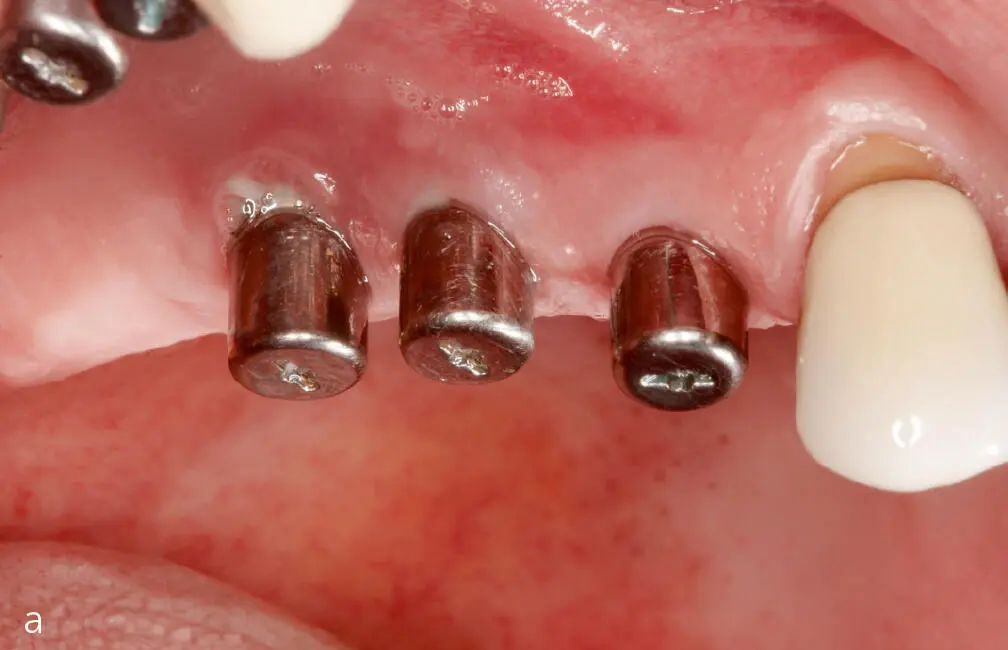 Abb 2a und b a Spontane Suppuration und b Blutung auf Sondierung und - фото 23