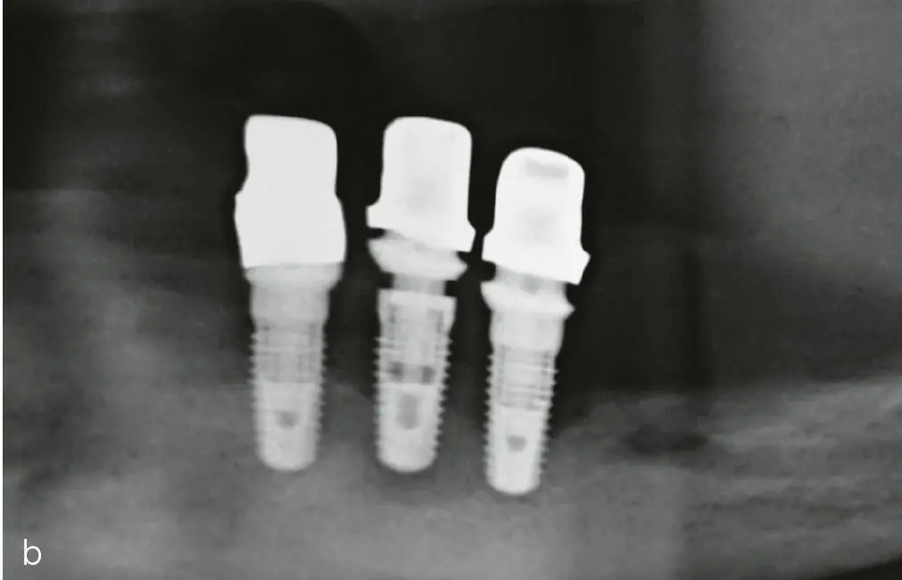 Abb 1a und b a Plaqueakkumulation an den Implantaten im Unterkiefer links b - фото 22
