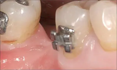 Fig 6a Preoperative view of site 46 at the end of orthodontic treatment - фото 53