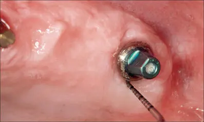 Fig 4l Oneyear follow up Healthy periimplant soft tissues with minimal - фото 40