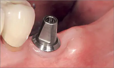 Fig 1a The implant was carefully selected and positioned in a periodontally - фото 16