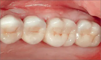 Fig 4k Fourunit cemented metalceramic bridge in situ Fig 4l Oneyear follow - фото 39