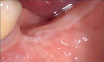 Figs 9de After three months site 35 presented with minimal keratinized mucosa - фото 87