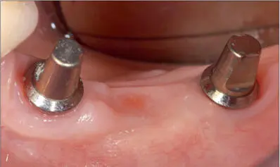 Figs 8ij Oneyear clinical and radiographic followup The prosthesis was - фото 80