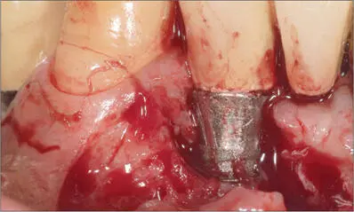 Fig 12c After raising a fullthickness flap the granulation tissue was removed - фото 114