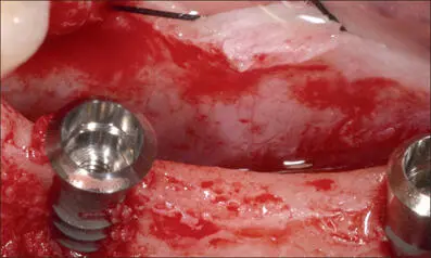Fig 8d Implants at sites 35 and 37 S RN diameter 33 mm length 10 mm and - фото 75
