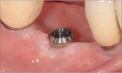 Fig 13g Six months after treatment Fig 13h New screwretained ceramic crown - фото 127