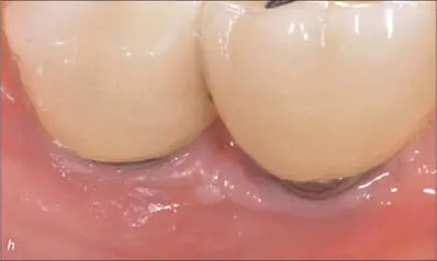 Figs 7hi Clinical and radiographic views of the screwretained ceramic crowns - фото 70