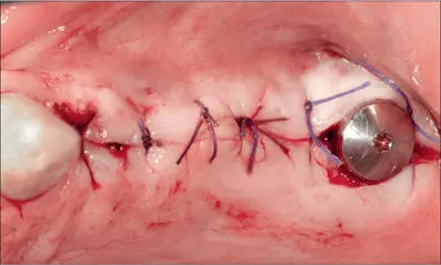 Fig 4h Semisubmerged healing in the anterior grafted area nonsubmerged - фото 36