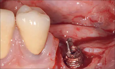 Figs 9ac Surgical removal of the fractured implant - фото 85