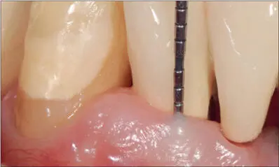 Fig 12h Minimal probing depth and no bleeding at the nineyear followup visit - фото 119