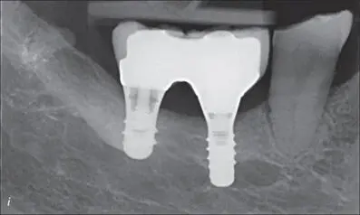 Figs 7hi Clinical and radiographic views of the screwretained ceramic crowns - фото 71