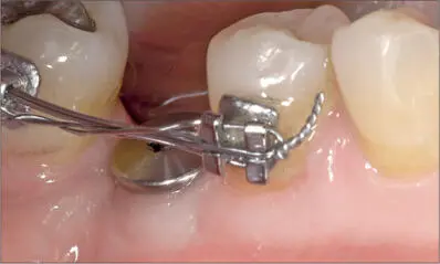 Fig 6i Early healing at six weeks A new mucogingival line is already - фото 61