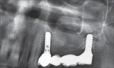 Fig 4m Radiograph at the fiveyear followup Stable interproximal bone levels - фото 41