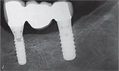 Figs 8ij Oneyear clinical and radiographic followup The prosthesis was - фото 81