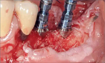Fig 9m After removal of the Timesh two Straumann Tissue Level implants were - фото 96