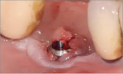 Fig 13b The crown and abutment were removed to provide access to the inflamed - фото 122