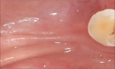 Fig 7c Edentulous area occlusal view Very thin crest Fig 7d Free gingival - фото 65