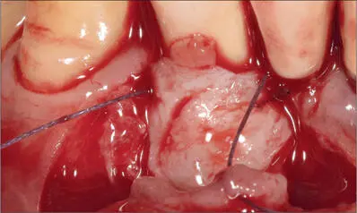 Fig 12e Connectivetissue graft taken from the maxillary tuberosity and - фото 116