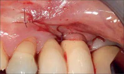Fig 10ce A trapezoidal splitthickness flap was elevated at the implant site - фото 104