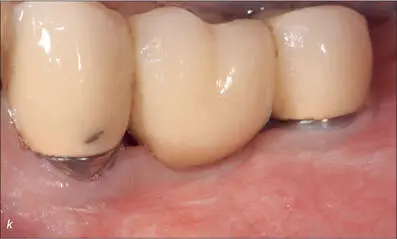 Figs 8kl Tenyear followup Minor pigmentation of the ceramic crown on the - фото 82