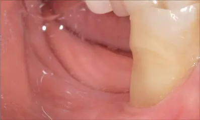 Fig 7b Edentulous area buccal view Very shallow vestibule and absence of - фото 64
