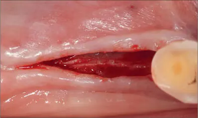 Fig 7f At three months a fullthickness flap was raised lingually and buccally - фото 68