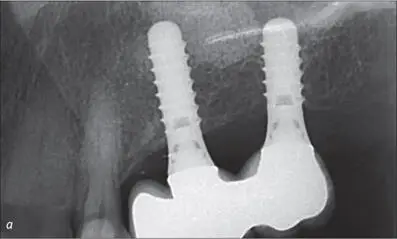 Fig 10ab Radiographic and clinical view of two implants SLA S diameter 41 - фото 100