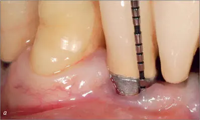 Fig 12ab Radiographic and clinical view of a hollowscrew implant placed in - фото 112