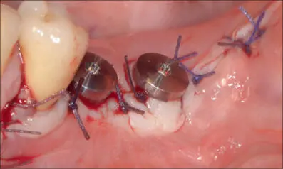 Fig 9n Sutures applied for optimal nonsubmerged healing Fig 9o Three months - фото 97