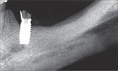 Figs 9ac Surgical removal of the fractured implant - фото 84