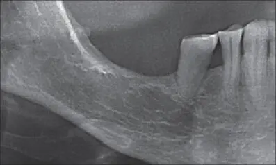 Fig 7a Panoramic radiograph of the edentulous sites 46 and 47 There is barely - фото 63