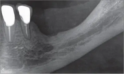 Figs 9de After three months site 35 presented with minimal keratinized mucosa - фото 88