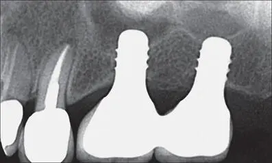 Fig 5k Periapical radiograph at eighteen months after implant placement - фото 52