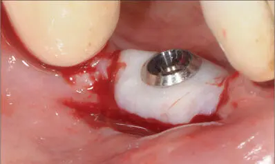 Fig 13e Precisely adapted FGG around the smooth collar of the implant Fig 13f - фото 125