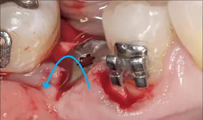 Fig 6ef The mesial papilla rotated 90 counterclockwise and sutured to the - фото 57