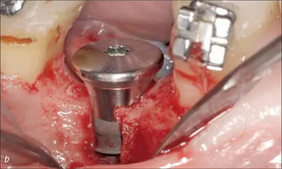 Fig 6bc Once the implant was placed S SLA diameter 41 mm length 12 mm - фото 54
