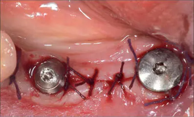 Fig 8f Sutures for transmucosal healing Ideal softtissue seal around the - фото 77
