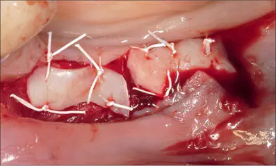 Fig 8b Two free gingival grafts sutured in the area where implant placement and - фото 73