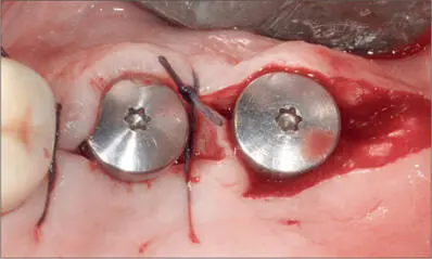 Fig 5g The pedicle was adapted with a 40 Vicryl vertical mattress suture - фото 48