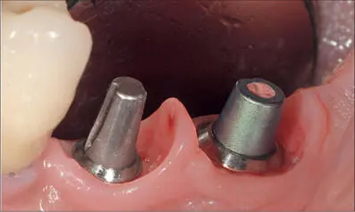 Fig 1b Healthy interdental papilla between two tissuelevel implants after - фото 17