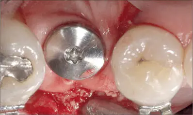 Fig 6d Resorbable collagen membrane prepared with a punched hole placed over - фото 56