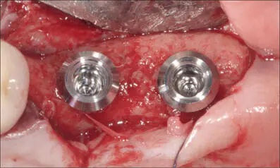 Fig 5c Two wideneck implants placed at sites 26 and 27 SP WNI SLActive - фото 44