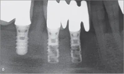 Fig 12ab Radiographic and clinical view of a hollowscrew implant placed in - фото 113