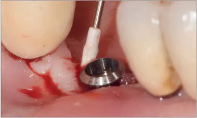 Fig 13c The treatment consisted of careful debridement and gentle cleaning of - фото 123